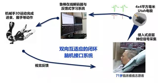 国内首例,浙大“双脑计划”让72岁高位截瘫患者只靠意念喝可乐打麻将