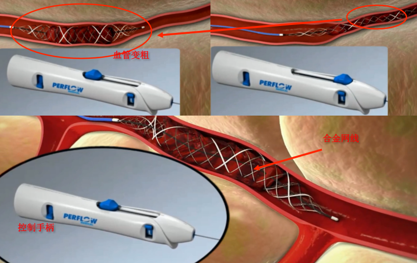 脑卒中治疗有了新突破，「Perflow」研发出回撤式机械取栓器