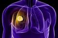 肺癌患者的福音：非小细胞靶向药物前景如何？