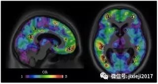 AI可提前两年预测老年痴呆，准确率为84％