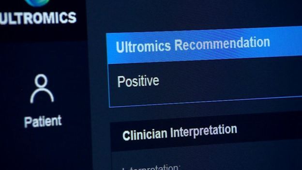 利用 AI 技术，「Ultromics」将冠心病的诊断准确率提高到了 90％