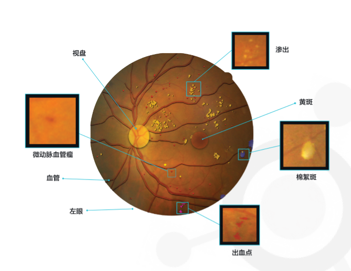 从眼底病变入手，肽积木说人工智能在医疗上的应用需要“知其所以然”