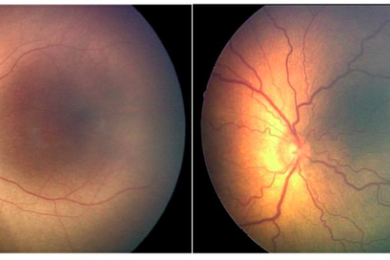 AI 超越人类的又一领域：新算法可筛查早产儿视网膜病变