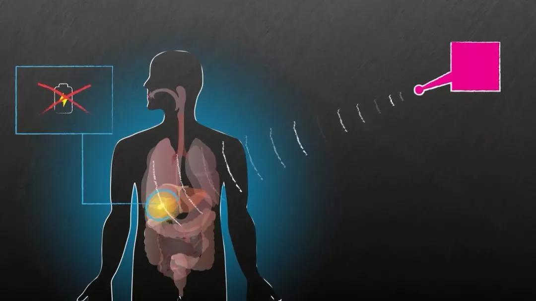 植入设备越来越多，“体联网”或许正在形成
