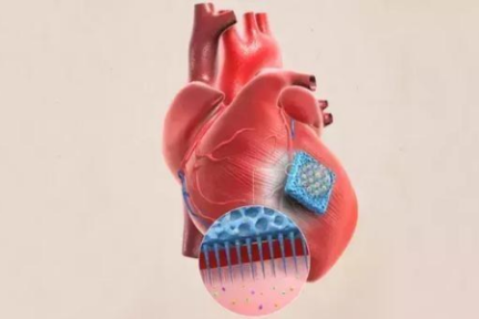潮科技 | 研发心脏专用“创可贴”，微针贴片或将用于修复治疗心脏组织