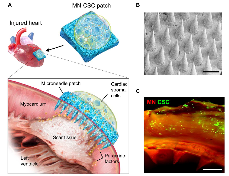 潮科技 | 研发心脏专用“创可贴”，微针贴片或将用于修复治疗心脏组织