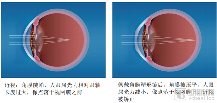角膜塑形镜国内市场增长迅速、规模或达200亿，仍面临三大挑战