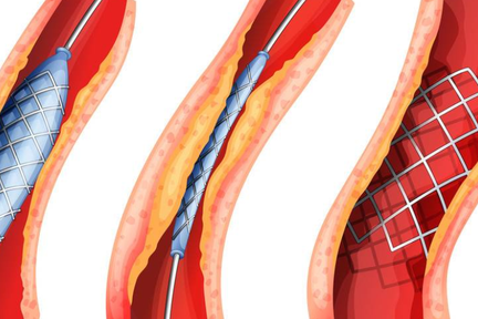 植介入成血管疾病治疗主流手段,「申淇医疗」自主研发药物涂层球囊