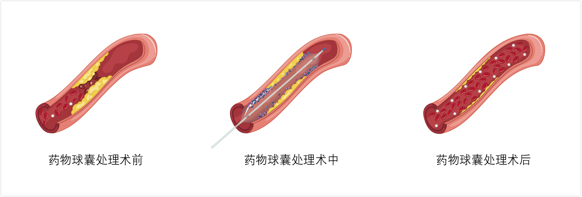 微创植介入成血管疾病治疗主流手段，「申淇医疗」自主研发药物涂层球囊