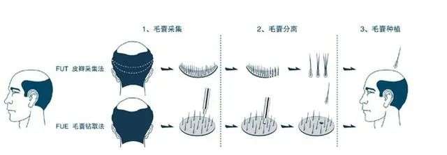 挺“秃”然的，我要去植发了……