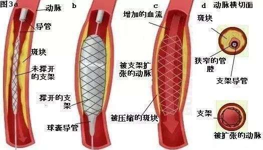 降价96%的冠脉支架辅助耗材，你敢用吗？
