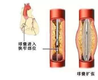 降价96%的冠脉支架辅助耗材，你敢用吗？