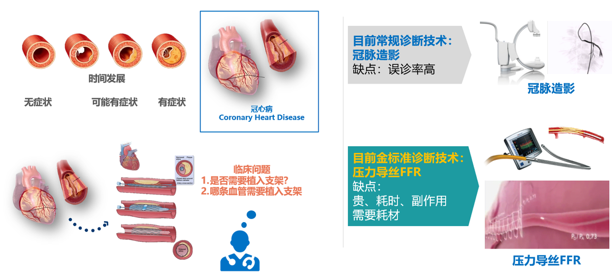 深钻计算冠脉功能学细分领域，「博动医学」完成数亿元B轮融资