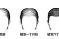 "秃"如其来的植发经济是一门好生意吗？