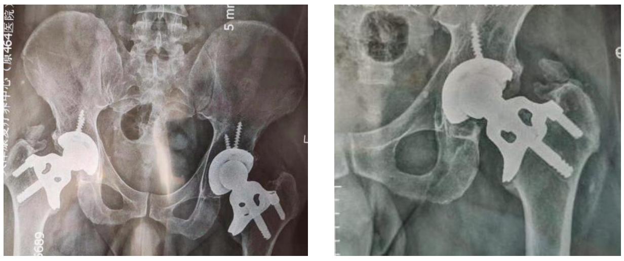 骨科手术，「富华医疗」研发仿生骨科耗材+多臂手术机器人
