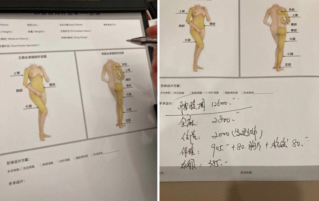 手术减肥_减肥手术后遗症_减肥手术有什么危害