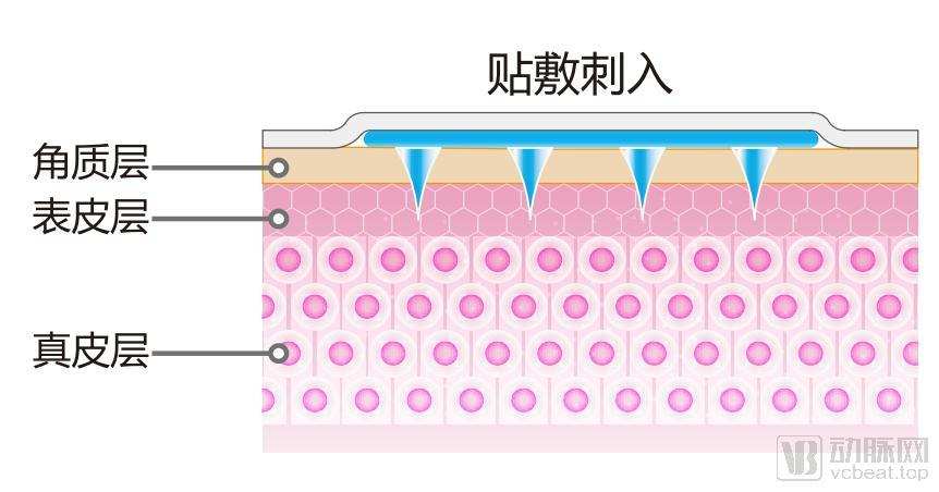 “小”微针，“大”前景，新型透皮给药方式正在点燃新赛道