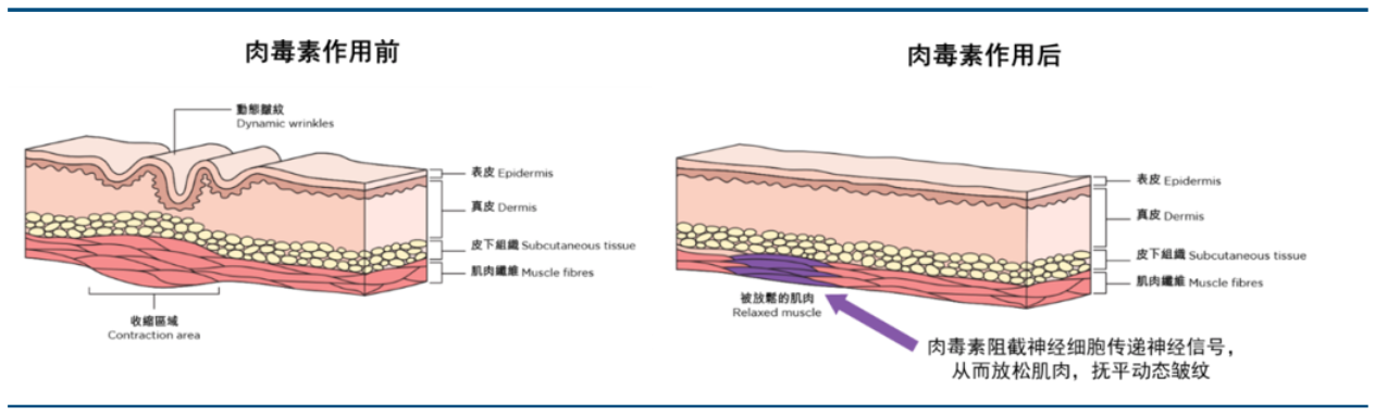 知料 | 没有肉毒素嘅玻尿酸卖唔动？“除皱神针”撑起百亿新赛道