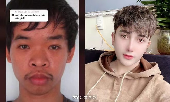 “男朋友沉迷做医美，花起钱来我都怕”