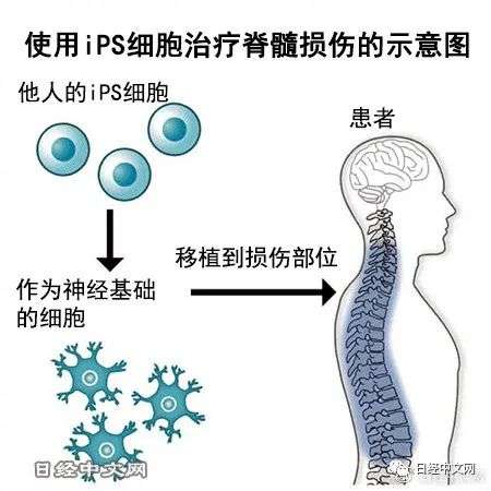 日本首次用iPS细胞治疗人类脊髓损伤(图1)