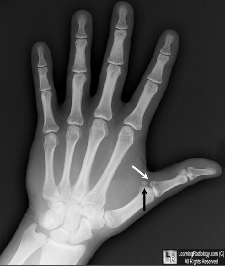 可用ok手势(拇指和食指相捏),初步自查是否发生了大拇指韧带损伤