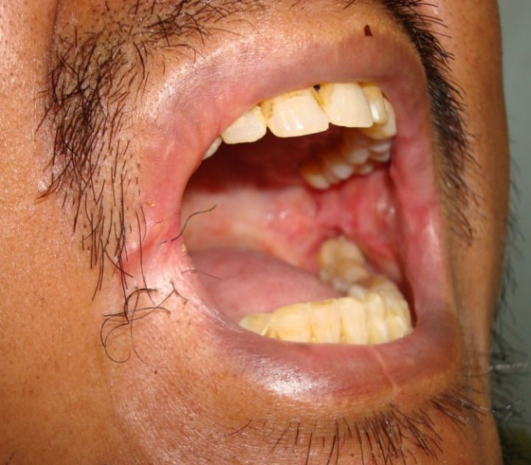 感染hpv舌头图片 症状图片
