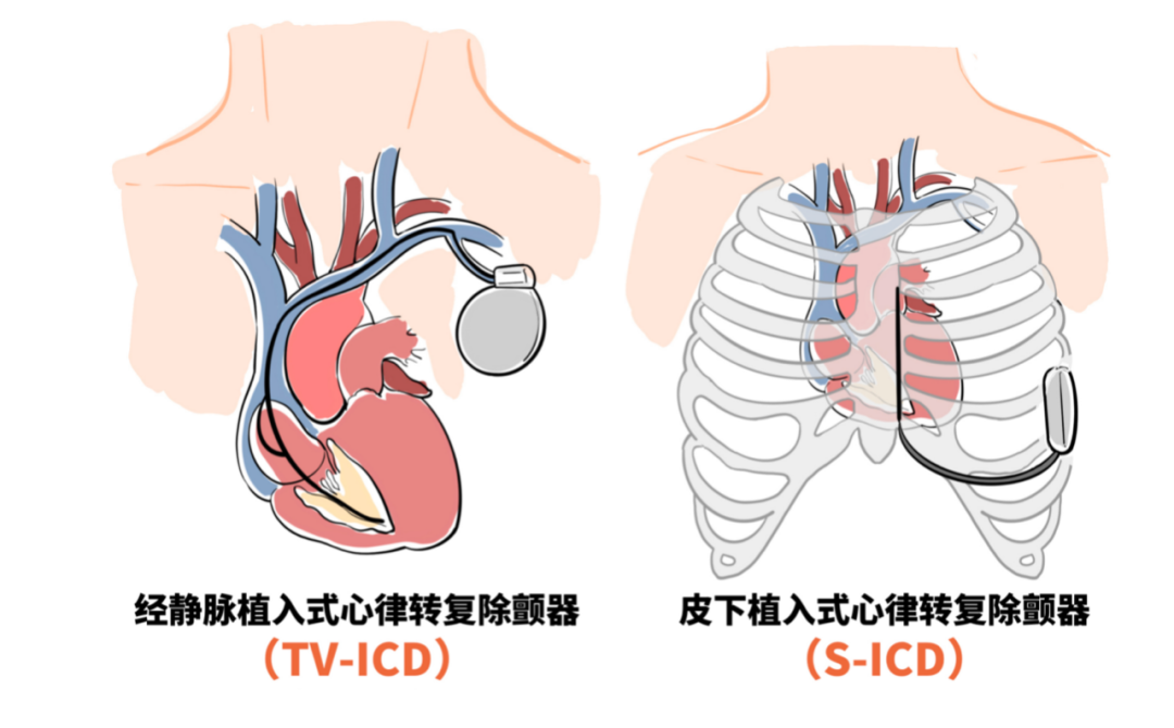 心脏性猝死可预防，专家呼吁高危人群植入“保命装置”