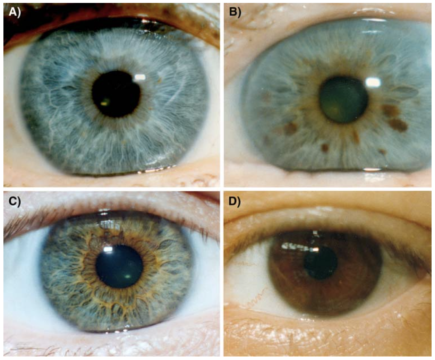 通常情况下,眼睛的颜色是指瞳孔周围虹膜的颜色,而虹膜的颜色又主要