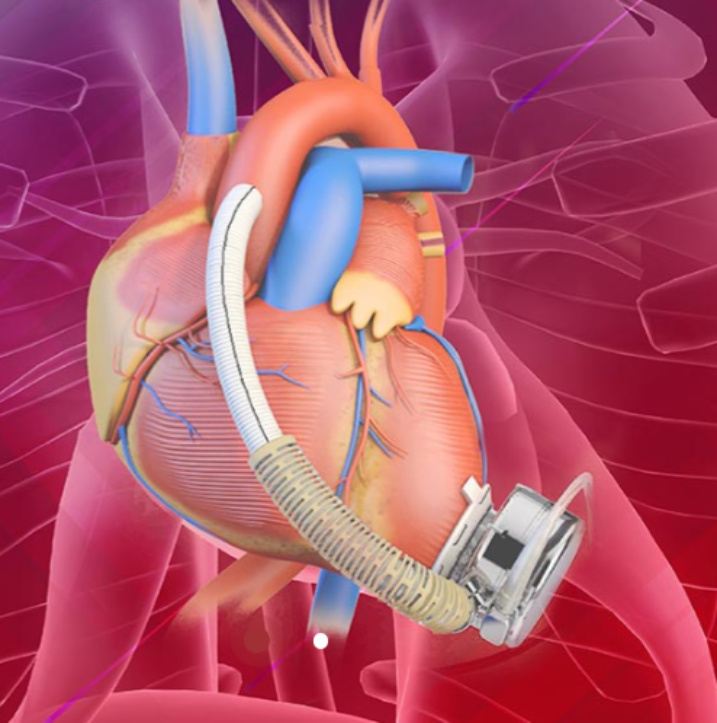 人工心脏