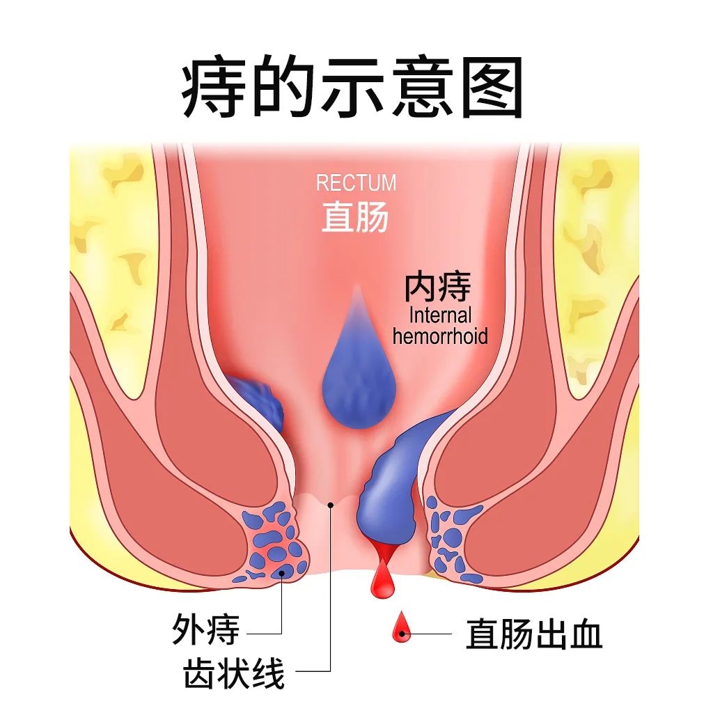 中国痔疮地图，哪里人的屁股最冒火_科普__健康160资讯网