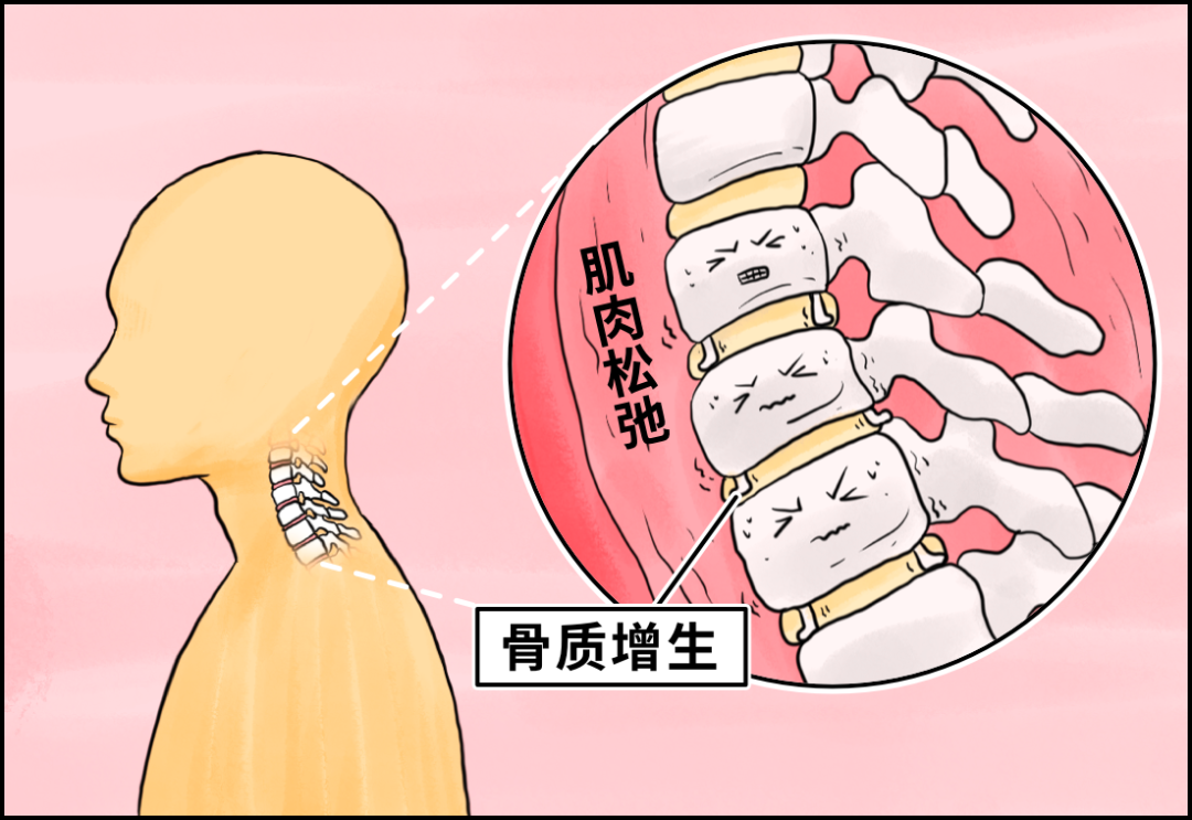 网上大火的「颈托」，劝你不要买-36氪