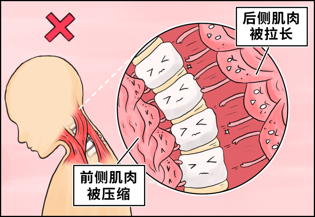 网上大火的「颈托」，劝你不要买-36氪