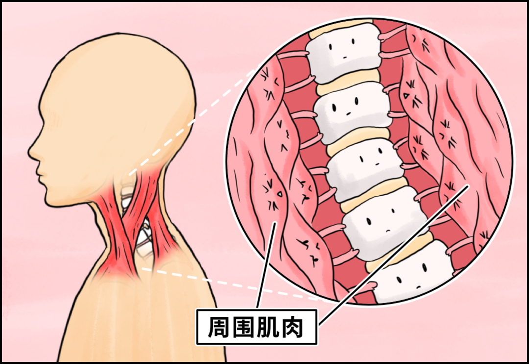 网上大火的「颈托」，劝你不要买-36氪