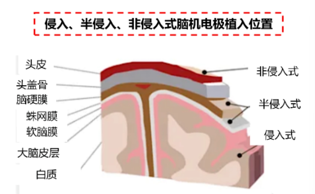 脑机接口虚火？但再不下手就晚了